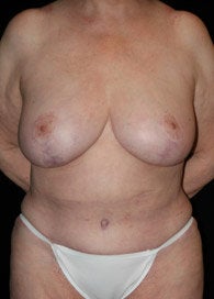 Body Lift