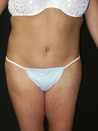 Body Lift