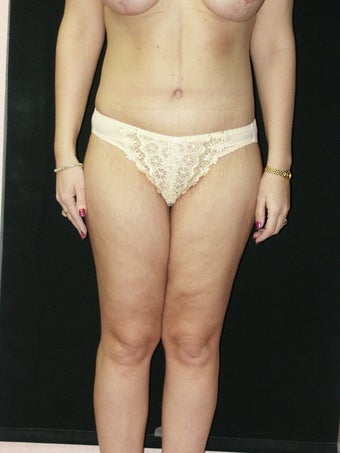 Body Lift  and Inner Thigh Lift
