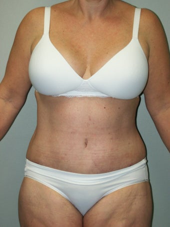 Belt Lipectomy