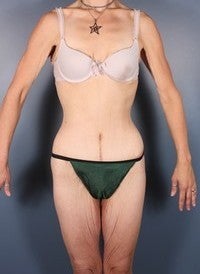 After Weight Loss, Body Lift