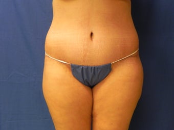 Body Lift