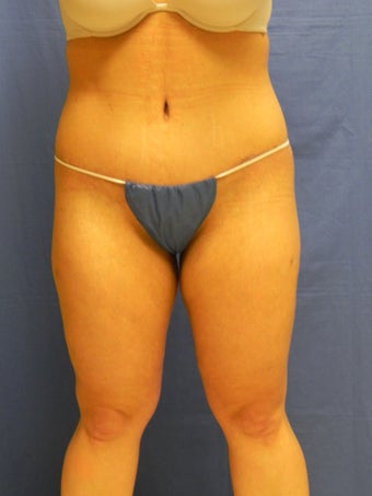 Body Lift