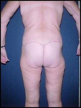 Body Lift after Massive Weight Loss