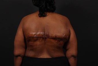 Bra Line Back Lift