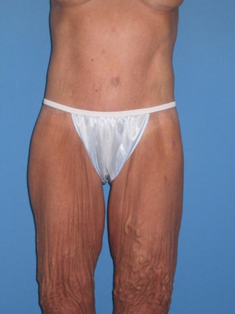 Torsoplasty