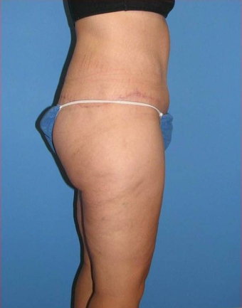 Body Lift