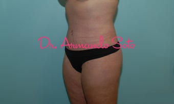 Body Lift after Large Weight Loss