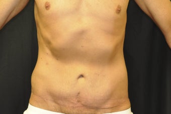 Body Lift