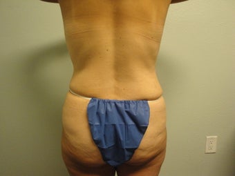 Body Lift 