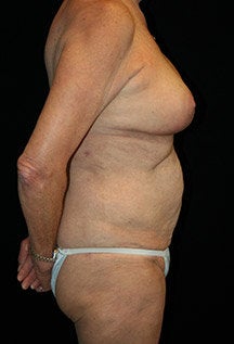 Body Lift