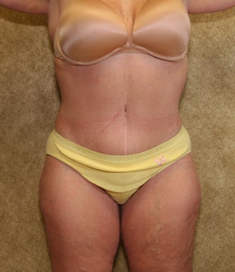 Body Lift after massive weight loss in los Angeles