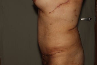 Abdominoplasty-Tummy Tuck with Liposuction