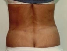 Body Contouring