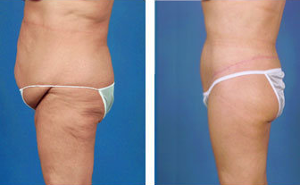 Lower body lift and tummy tuck post gastric bypass surgery - age 57