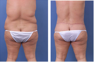 Central body lift with liposuction of thighs and back, age 42