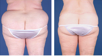 Central body lift with liposuction age 53