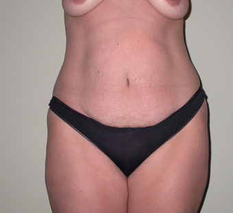 Breast lift, abdominoplasty, liposuction
