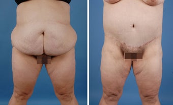 Bilateral Lower Body Lift and Liposuction