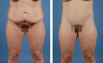Lower Body Lift and Liposuction of Lateral Thighs