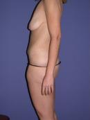 Body Lift