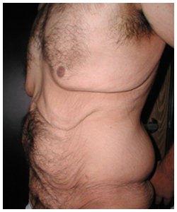 Body Lift and Male Breast Reduction