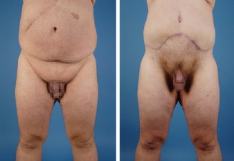 Upper & Lower Body Lift