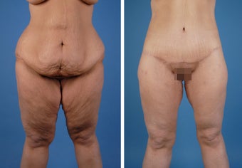 Lower Body Lift and Thighplasty