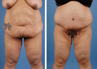 Lower Body Lift and Extended Tummy Tuck