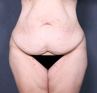 Body Lift