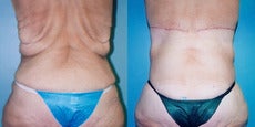 Upper Body & Back Lift After Major Weight Loss