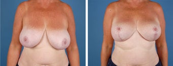 Breast Lift