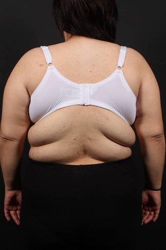 Bra Line Back Lift