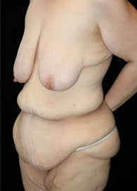 Body Lift