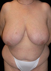Body Lift