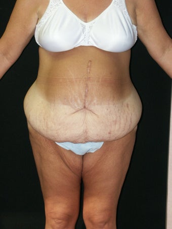 Body  Lift