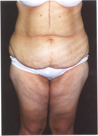 Body Lift  and Inner Thigh Lift