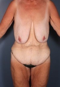 After Weight Loss, Body Lift, Breast Lift
