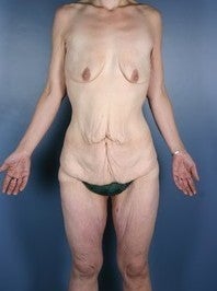 After Weight Loss, Body Lift