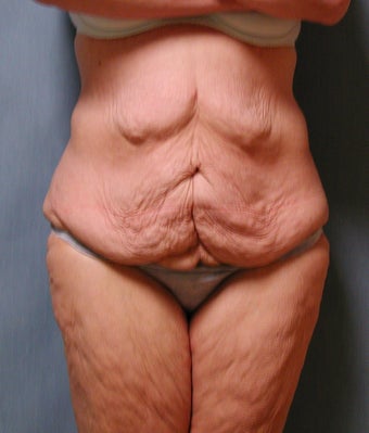 Lower Body Lift