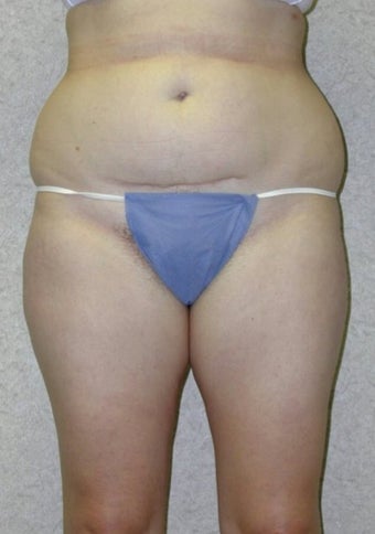 Lower Body Lift