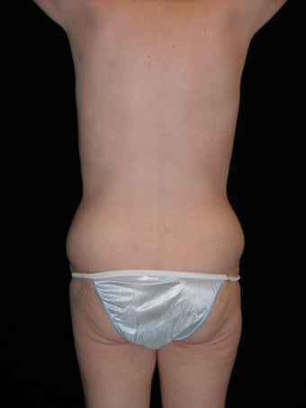 Body lift after weight loss