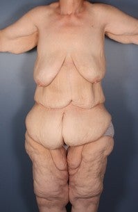 Posterior Body Lift, Medial Thigh Lift, Pannicuctomy