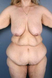 Body Lift, Medial Thigh Lift, Arm Lift, Breast Reduction