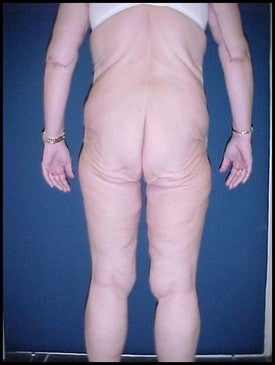 Body Lift after Massive Weight Loss