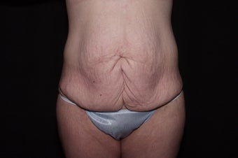 Body Lift