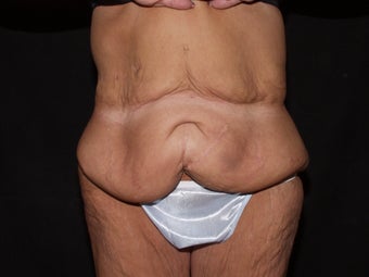 Body Lift