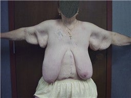 Body Lift