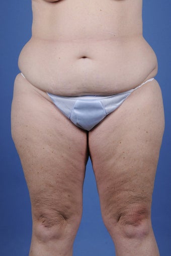 Body lift