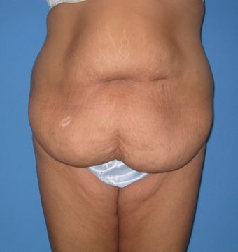 Torsoplasty